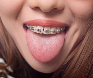 ¿Qué alimentos puedo comer durante la ortodoncia?