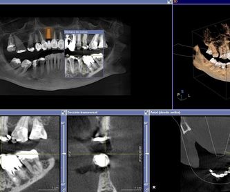 Odontología general: Servicios de Clínica Implanteoral Milladoiro