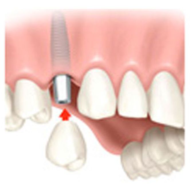 Ventajas y desventajas de los implantes dentales