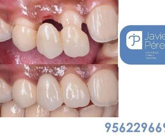 Implantes  : Servicios   de Clínica Dental Dr. Javier Pérez Martínez N.I.C.A. 27795