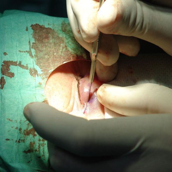 ¿Por qué someterse a una blefaroplastia?