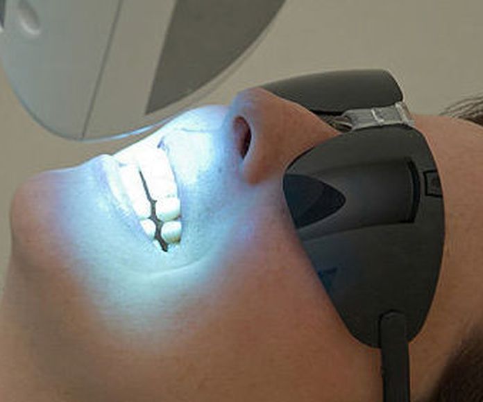 Blanqueamiento dental  : Tratamientos de Clínica Dental Center