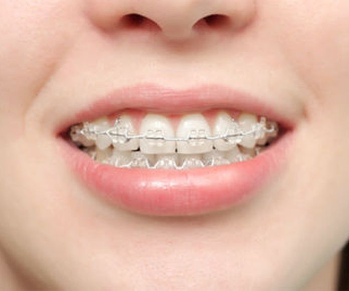 Ortodoncia: Servicios de Clínica Dental Gregori Lloria