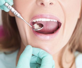 Implantología: Servicios de Clínica Dental Coll Favà