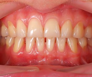 Circunstancias en las que acudir urgentemente al dentista