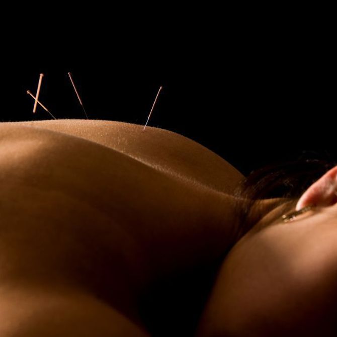 Cómo usar la acupuntura para el dolor de espalda