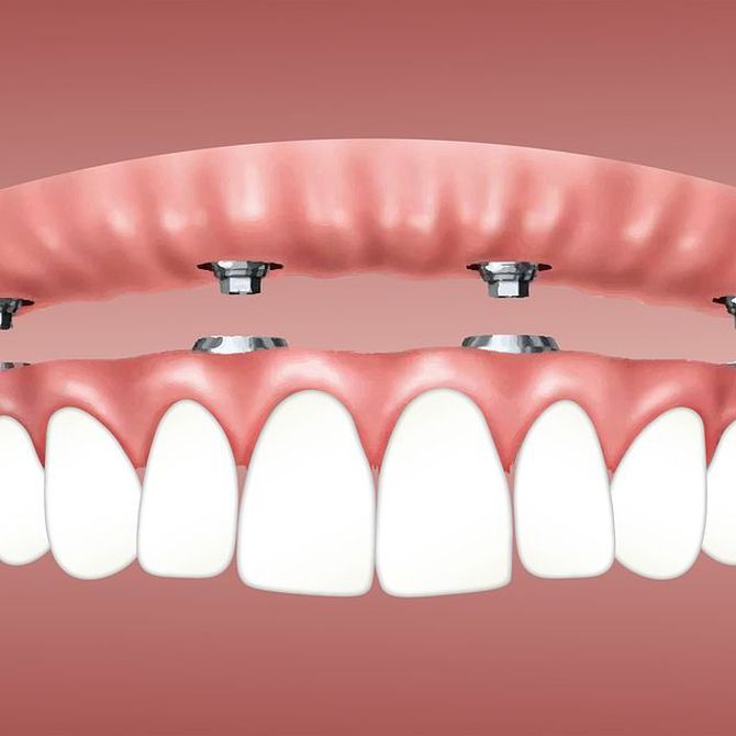 ¿Cómo se coloca un implante dental?