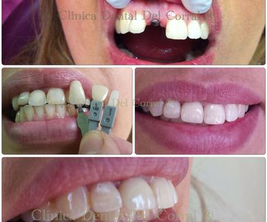 Mejor dentista de implantes dentales en madrid