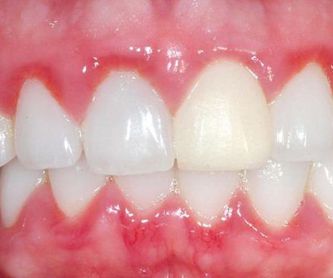 Estética dental: Servicios de Vila Dental Dra. Sonia Molina