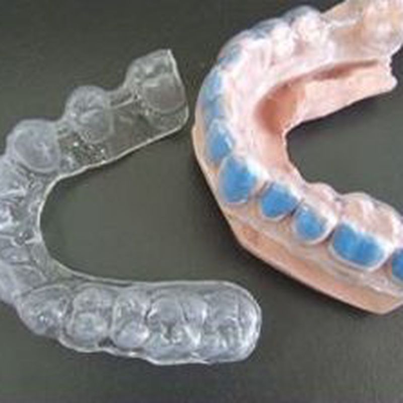 Otros tipos de prótesis: Servicios de Ángel Dueñas Laboratorio Dental