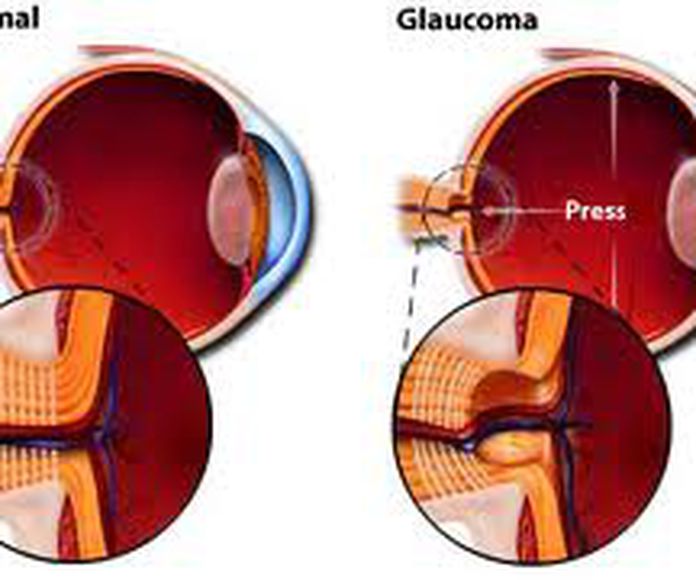 cirugía del glaucoma