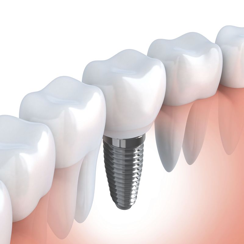 Implants i pròtesis: Tractaments de Clínica Dental Santa Marta