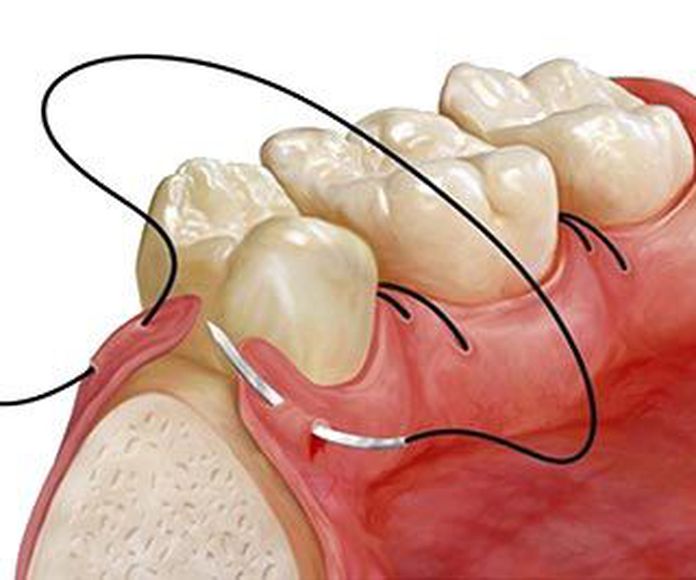 Cirugía: Tratamientos de Clínica Dental Ruiz Jalón