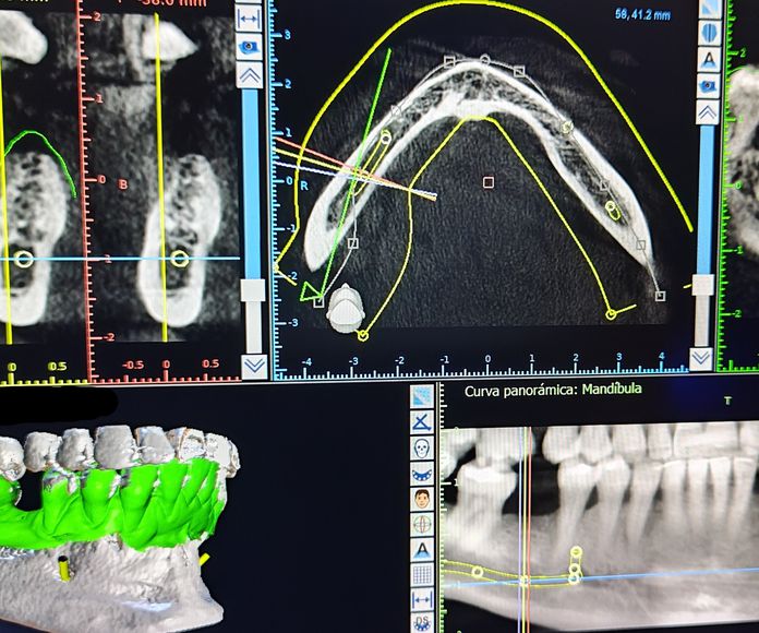Esáner intraoral y radilogía tridimensional: Tratamientos y Productos de Odontología Integral Fernando Román