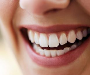 Carillas dentales: económicas, rápidas de colocar y duraderas