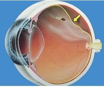 Degeneración macular asociada a la edad: Patologías oculares de Oftalmólogo Cristina Mantolán Sarmiento