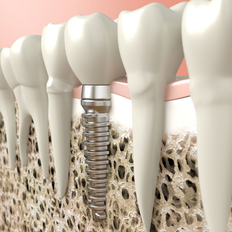 Implantes: Tratamientos de Clínica Dental Espartales - José Antonio Narváez