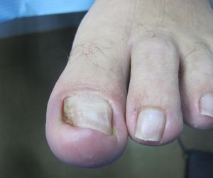 uñas encarnadas