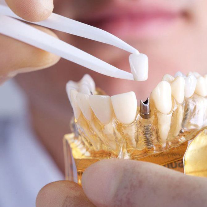 Requisitos para la colocación de implantes dentales
