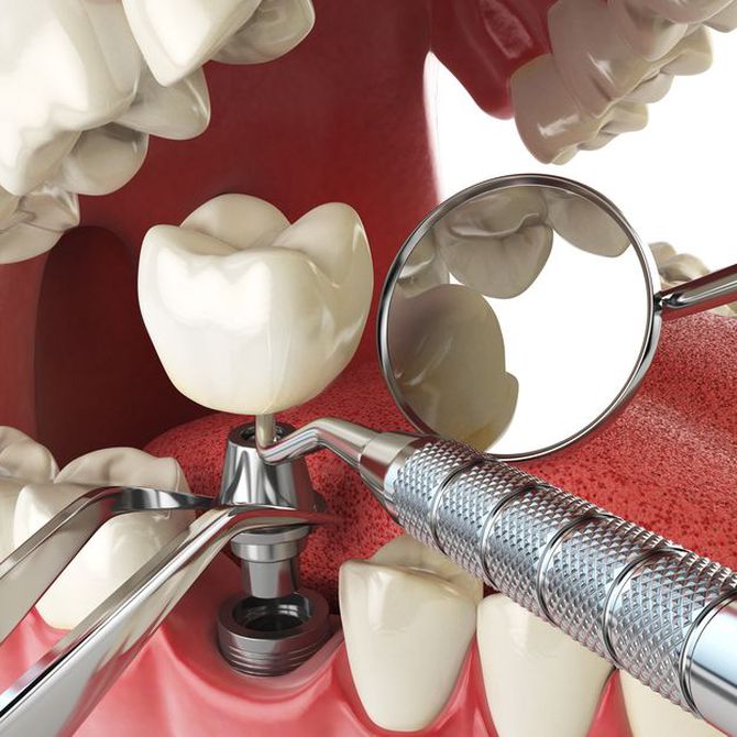 ¿Sabes cómo se ponen los implantes dentales?