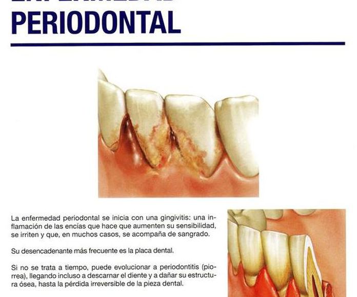 Enfermedad periodoncial: Especialidades  de Clínica Dental Vistalegre }}