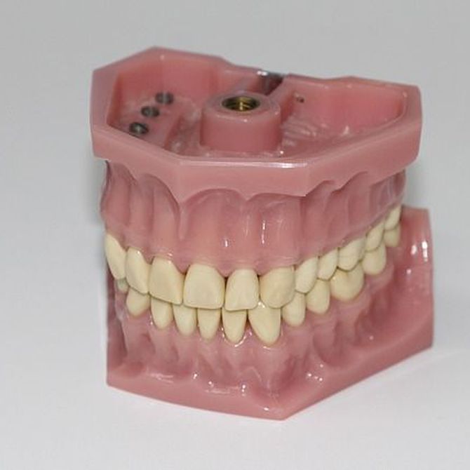 Prótesis dentales fijas o removibles
