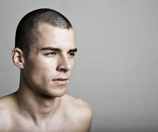 Alopecia hombres