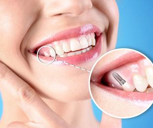 ¿Se puede hacer la colocación de un implante dental con poco hueso?