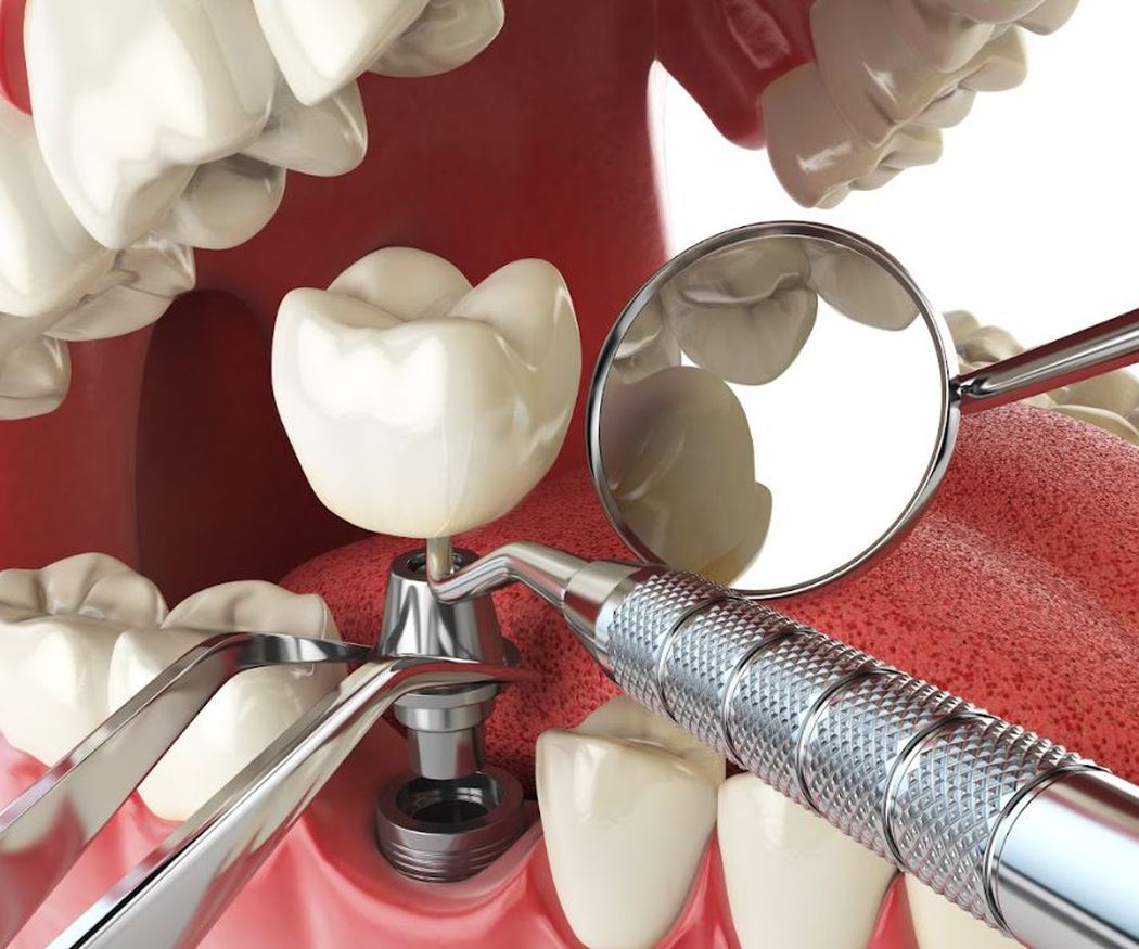Beneficios de un implante dental
