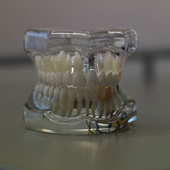 Tipos de prótesis dentales removibles y sus ventajas