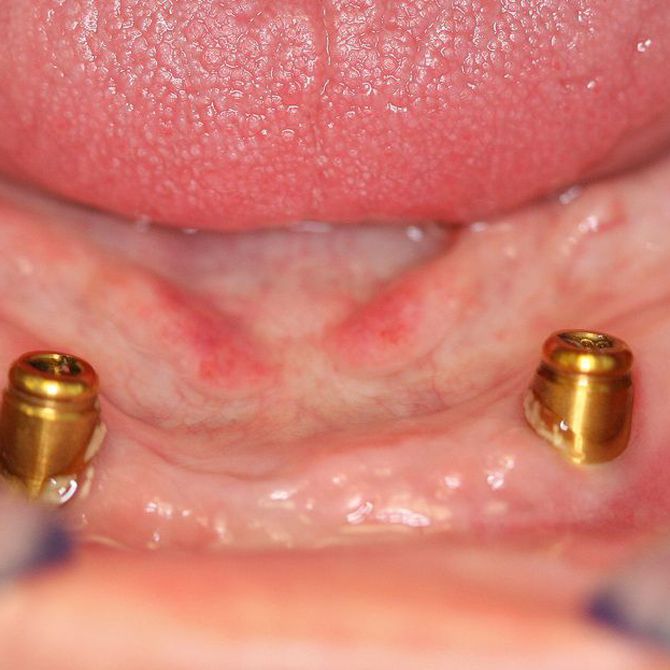 ¿Qué son los implantes dentales?