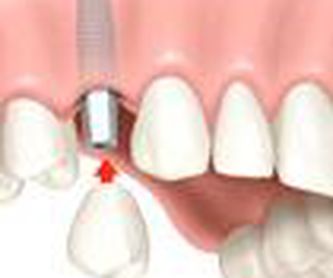 Odontología preventiva: Nuestros servicios de Sant Hilari Centre odontològic
