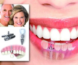 Implantes dentales, cómo son y cómo se colocan