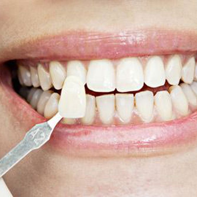 ¿En qué se diferencian las fundas de las carillas dentales?