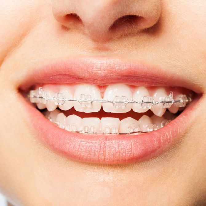 La estética de la ortodoncia invisible