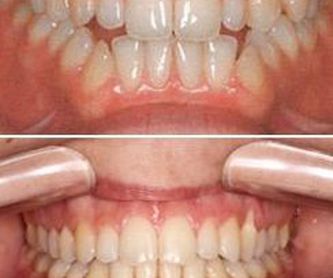 Ortodoncia invisible: Tratamientos de Ortodoncia Carlton
