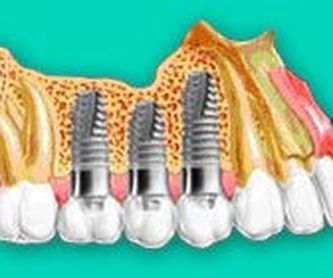 Endodoncia: Servicios de Clínica Dental Barakaldo