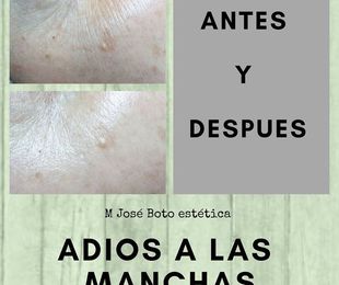 Eliminar manchas en la piel