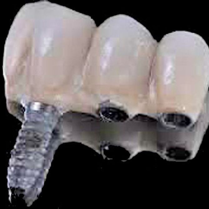 ¿Con qué material se hacen los implantes dentales?