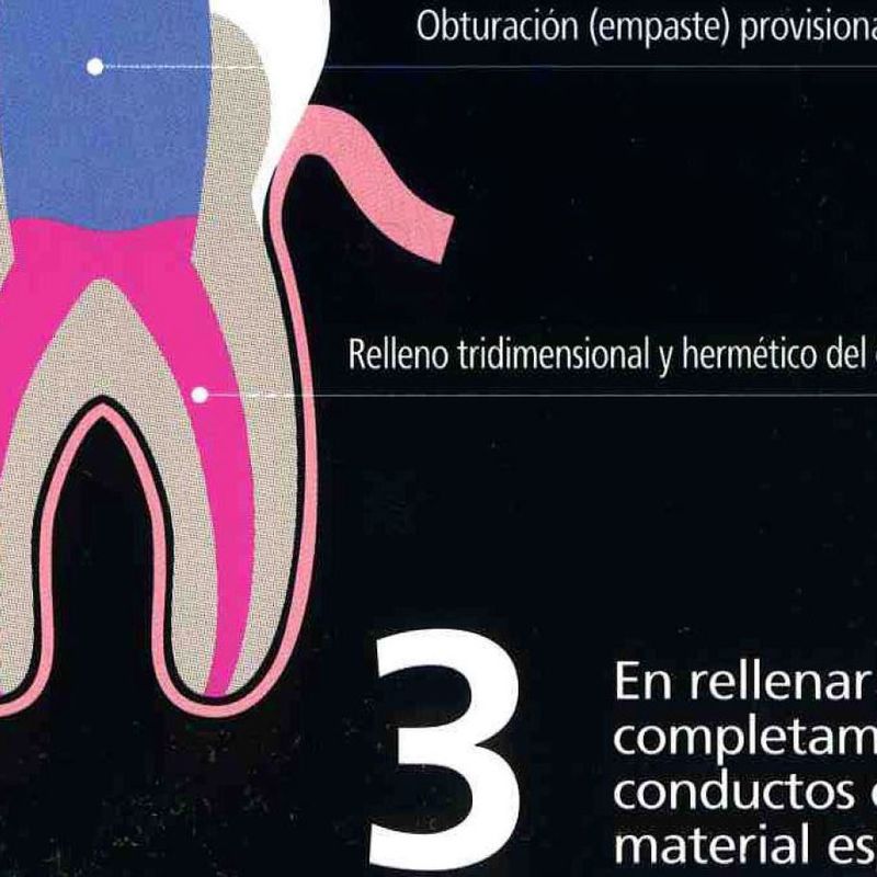 Endodoncia: Servicios   de Clínica Dental Dr. Javier Pérez Martínez N.I.C.A. 27795