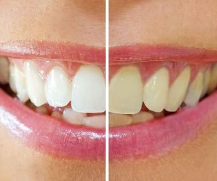 Estética dental: Tratamientos de Clínica Dental Ruiz Jalón