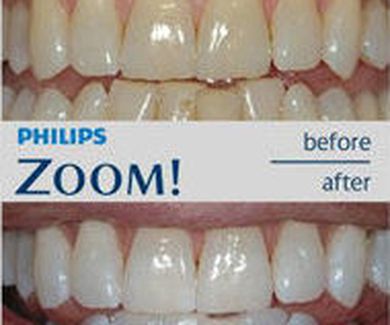 Promoción Blanqueamiento Zoom de Philips
