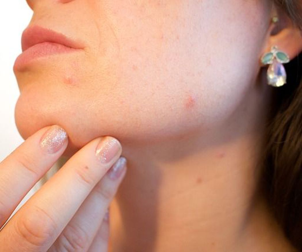 ¿Qué efecto tienen las limpiezas de cutis sobre el acné?