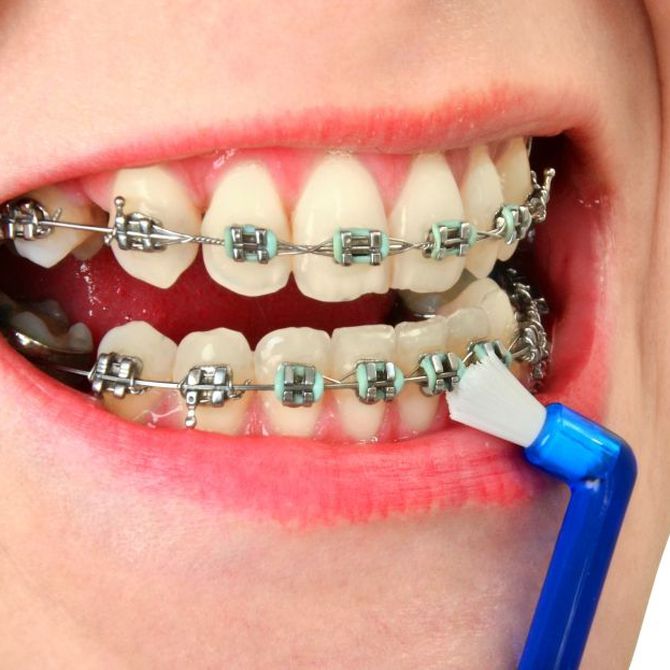 Una higiene para cada tipo de ortodoncia