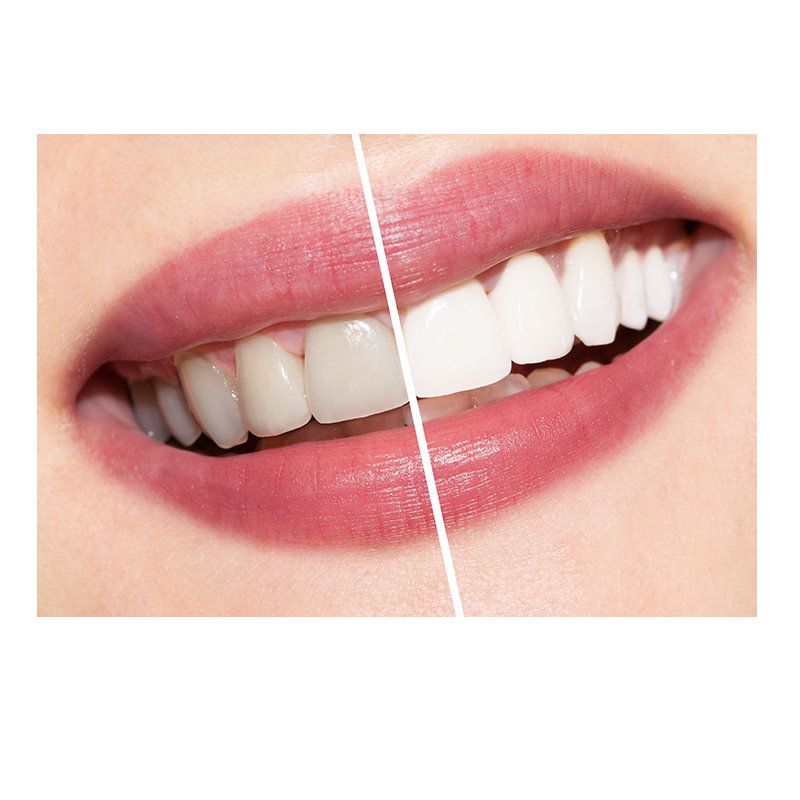 Odontología estética: Servicios de Dental Implantes