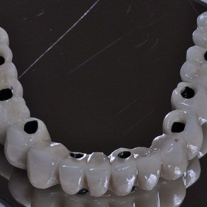 Implantes de carga inmediata para mejorar tu estética dental