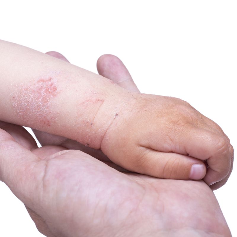 Dermatitis: Servicios de Pujol Montcusí. Dr.