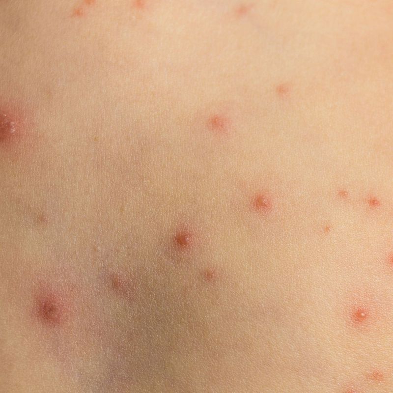 Moluscos Contagiosos: Dermatología y Dermoestética de Dermatología Socorro Fierro