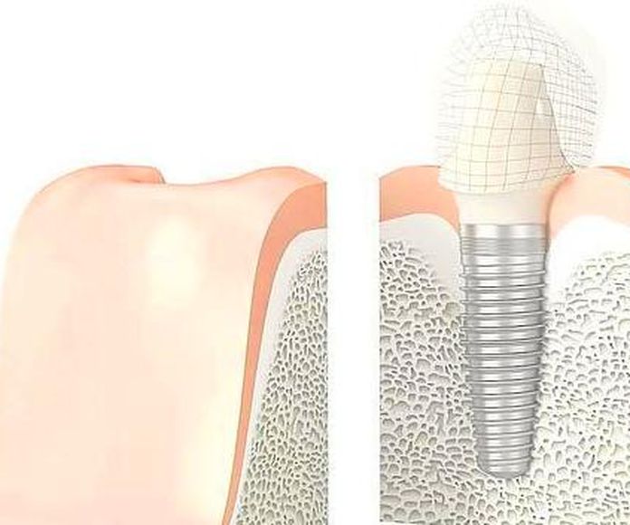 Implantología dental en A Coruña
