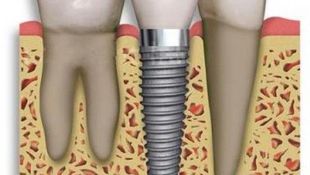 Imagen de Tratamientos - Implantes dentales
